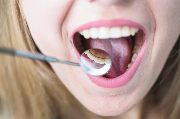 tipos de aparelho mulher com boca aberta no dentista