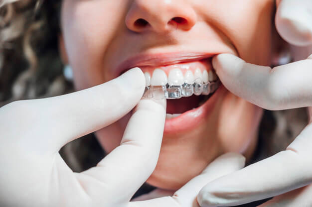 https://ortoeto.com.br/wp-content/uploads/2020/11/dentista-aplicando-alinhadores-transparentes.jpg