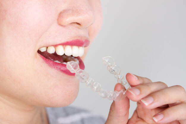 Alinhadores transparentes x aparelho fixo: qual o melhor para saúde bucal?  - Saúde Debate