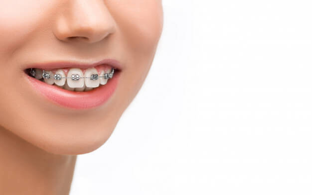 ortodontia estética aparelho fixo