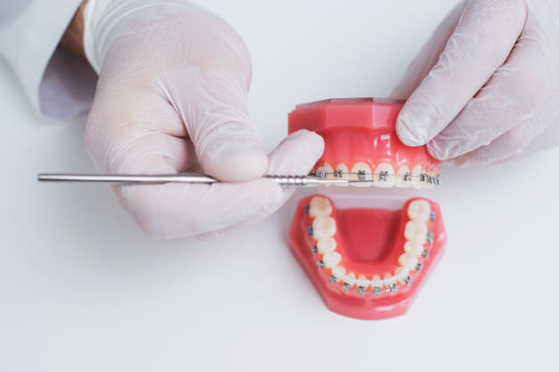 dentista mostrando aparelho convencional