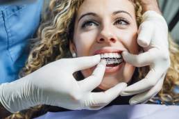 dentista colocando aparelho ortodôntico estético