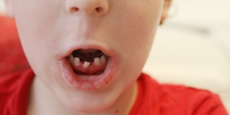 aparelho de crianca aparelho ortodontico na infancia