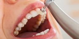 limpeza-dental-limpeza dental nome tecnico